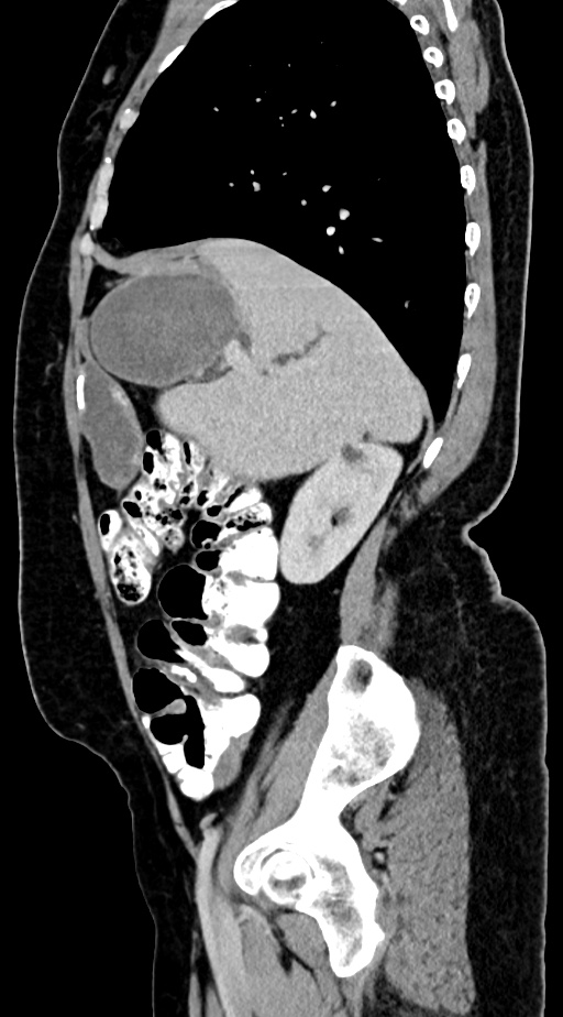 Abdominal hydatid disease (Radiopaedia 68223-77737 Sagittal C+ portal venous phase 51).jpg