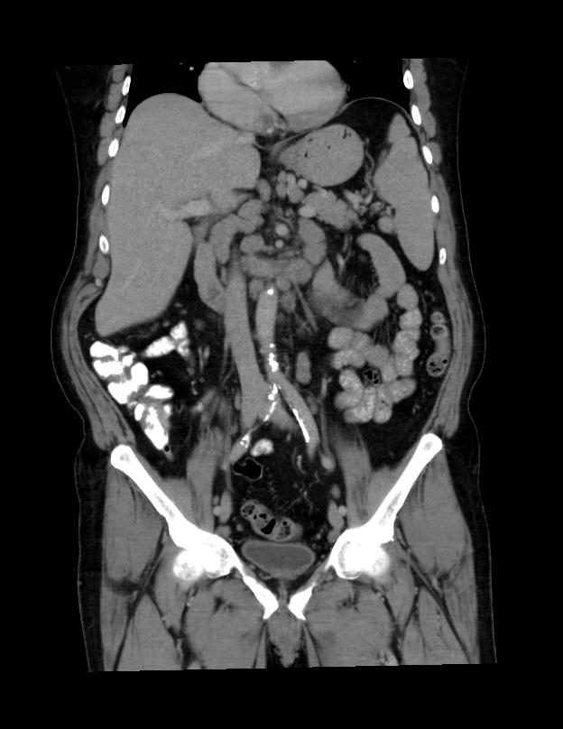 Abdominal lymphoma - with sandwich sign (Radiopaedia 53486-59492 C+ portal venous phase 30).jpg