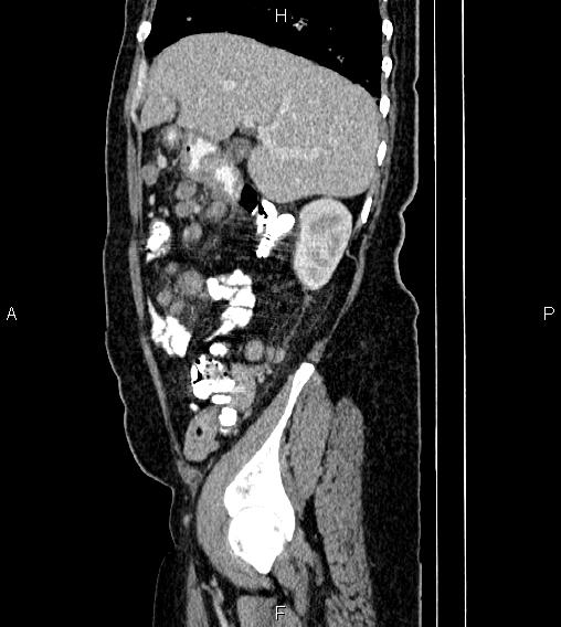 File:Abdominal lymphoma with sandwich sign (Radiopaedia 84378-99704 Sagittal C+ portal venous phase 18).jpg