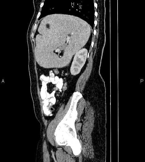 Abdominal lymphoma with sandwich sign (Radiopaedia 84378-99704 Sagittal C+ portal venous phase 73).jpg
