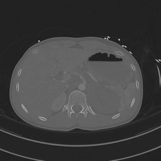 File:Abdominal multi-trauma - devascularised kidney and liver, spleen and pancreatic lacerations (Radiopaedia 34984-36486 I 91).png