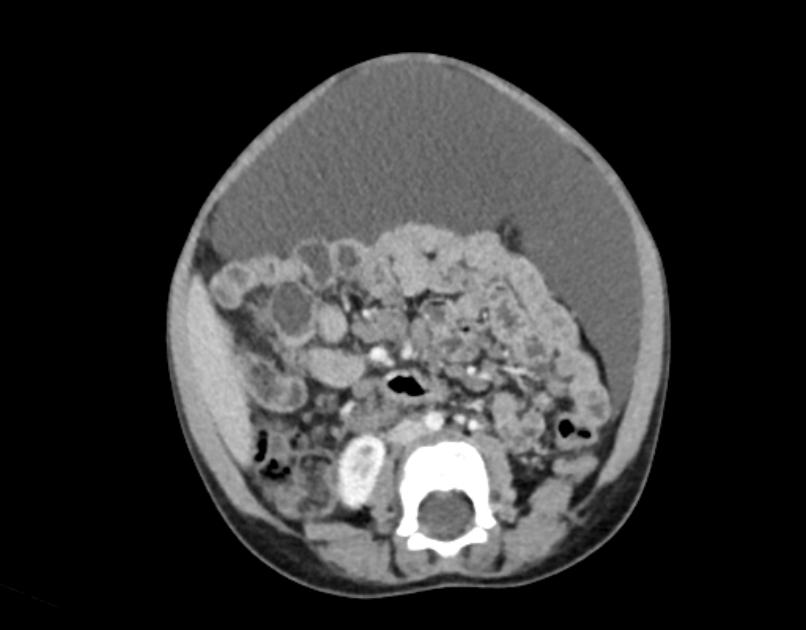 Abdominal premesenteric cystic lymphangioma (Radiopaedia 82995-97350 Axial C+ portal venous phase 34).jpg