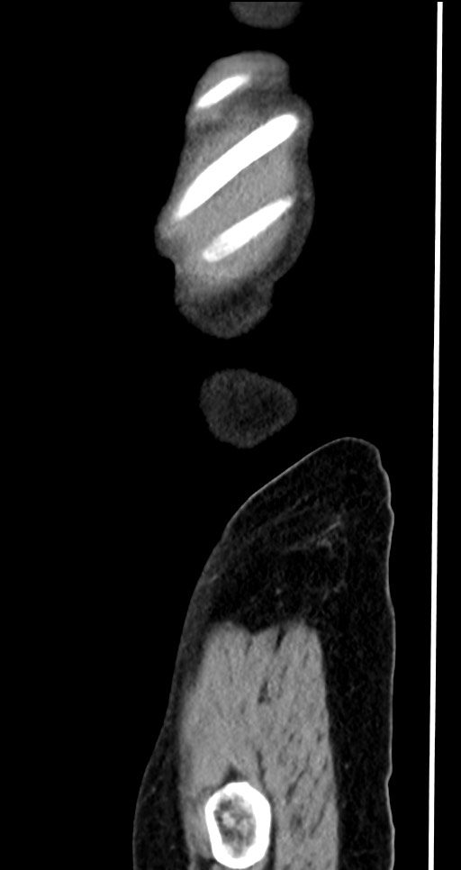 Abdominal wall and retroperitoneal tuberculosis (Radiopaedia 88137-104729 Sagittal C+ portal venous phase 12).jpg