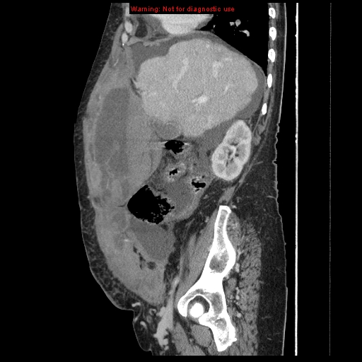 Abdominal wall hematoma (Radiopaedia 9427-10112 Sagittal C+ portal venous phase 75).jpg