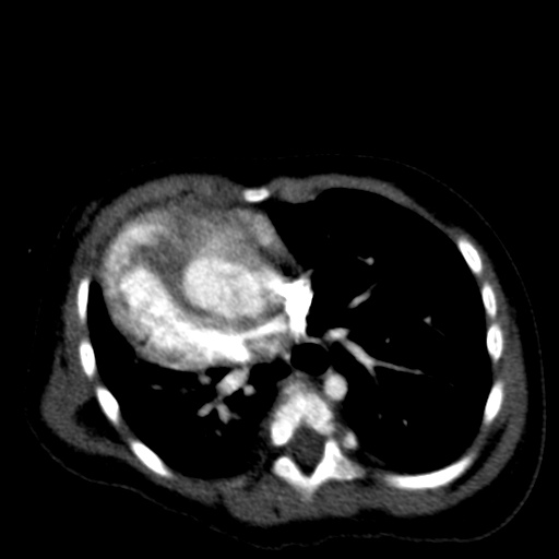 File:Aberrant left pulmonary artery (pulmonary sling) (Radiopaedia 42323-45435 Axial C+ CTPA 29).jpg