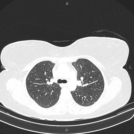 File:Aberrant right subclavian artery (Radiopaedia 87334-103629 Axial lung window 26).jpg