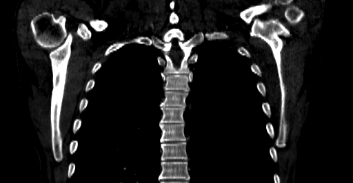 File:Accesory rib joint (Radiopaedia 71987-82452 Coronal bone window 37).jpg
