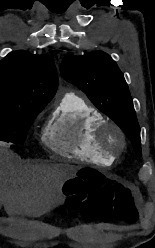 Accessory left atrial appendage (Radiopaedia 81987-95968 Coronal C+ arterial phase 9).jpg