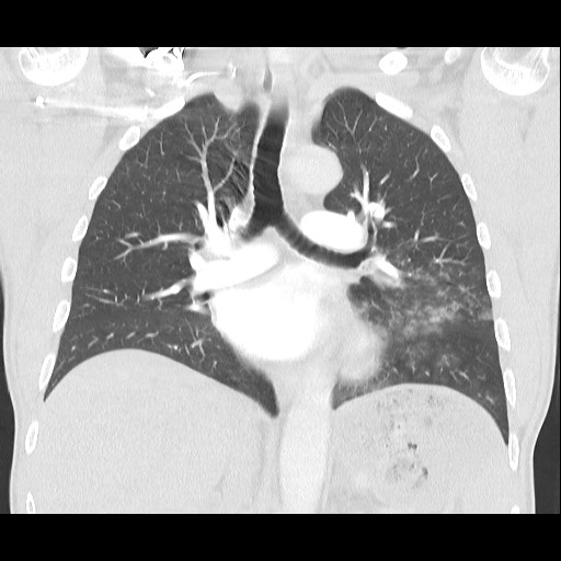 Accessory left horizontal fissure with lingular pneumonia (Radiopaedia 53763-59843 Coronal lung window 25).jpg