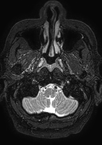 Accessory middle cerebral artery (Radiopaedia 73114-83828 Axial T2 211).jpg