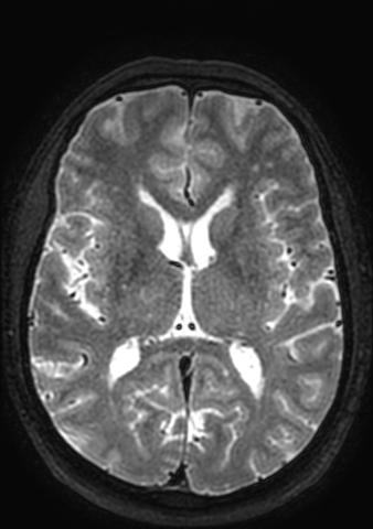 Accessory middle cerebral artery (Radiopaedia 73114-83828 Axial T2 60).jpg