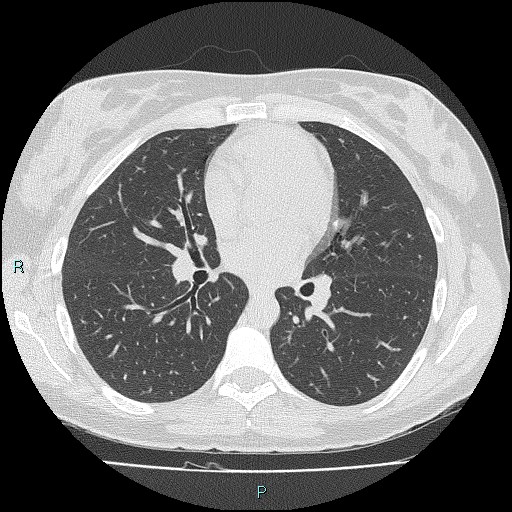 File:Accidental foreign body aspiration (seamstress needle) (Radiopaedia 77740-89983 Axial lung window 34).jpg