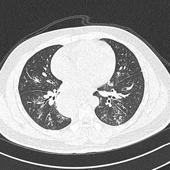 Achalasia with aspiration (Radiopaedia 55413-61845 Axial lung window 43).jpg