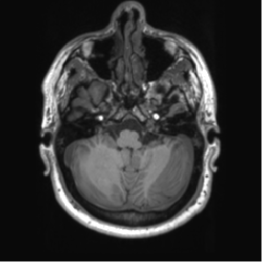 File:Achondroplasia (Radiopaedia 65109-74105 Axial T1 44).png