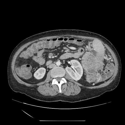 Acinar cell carcinoma of the pancreas (Radiopaedia 75442-86669 Axial C+ portal venous phase 71).jpg