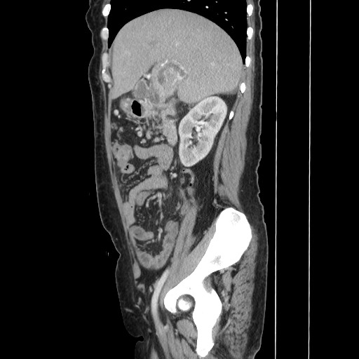 Acinar cell carcinoma of the pancreas (Radiopaedia 75442-86669 Sagittal C+ portal venous phase 67).jpg