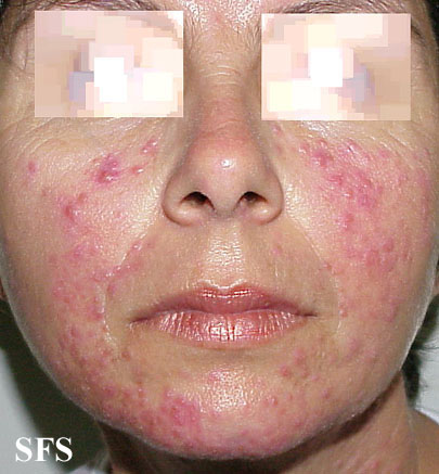 Acne Rosacea (Dermatology Atlas 9).jpg
