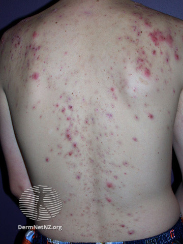 File:Acne affecting the back images (DermNet NZ acne-acne-back-173).jpg