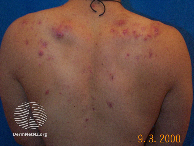 File:Acne affecting the back images (DermNet NZ acne-acne-back-185).jpg