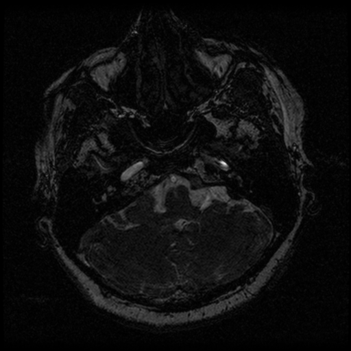 Acoustic schwannoma (Radiopaedia 33045-34060 Axial T2 15).png