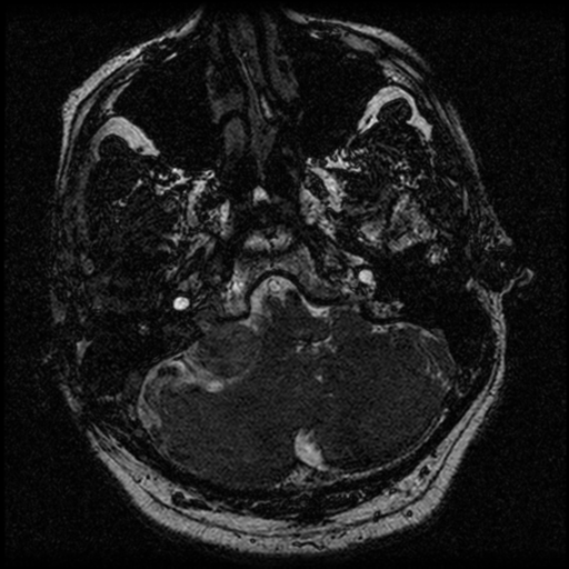 File:Acoustic schwannoma (Radiopaedia 39170-41387 Axial FIESTA 43).png