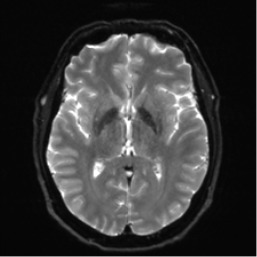 File:Acoustic schwannoma (Radiopaedia 50846-56358 Axial DWI 15).png
