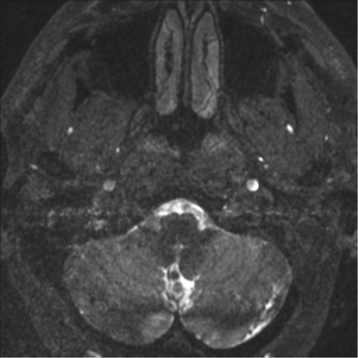 Acoustic schwannoma (translabyrinthine resection) (Radiopaedia 43570-46972 Axial CISS 1).png