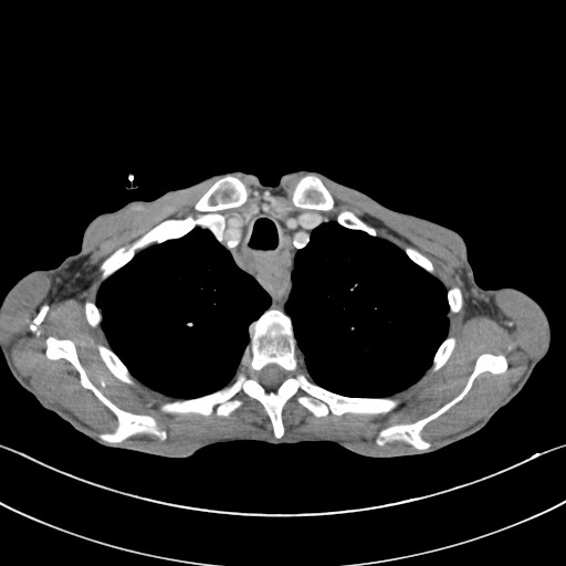 File:Acquired tracheoesophageal fistula (Radiopaedia 57747-65042 Axial C+ portal venous phase 18).jpg