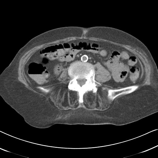 Active bleeding from duodenal ulcer with embolization (Radiopaedia 34216-35481 Axial non-contrast 38).png