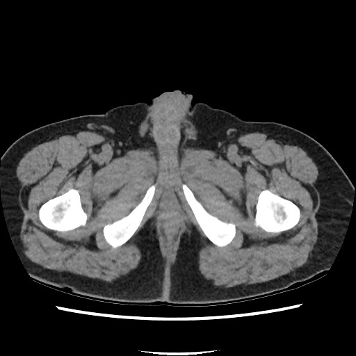 File:Active colonic bleed on CT (Radiopaedia 49765-55025 Axial non-contrast 90).jpg