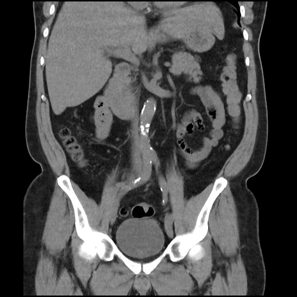 Active colonic bleed on CT (Radiopaedia 49765-55025 Coronal non-contrast 28).jpg