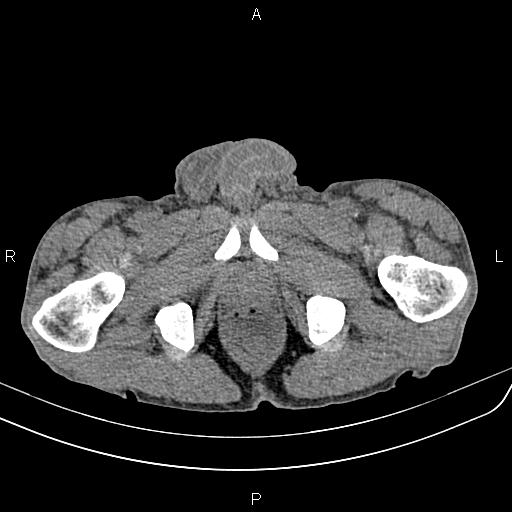 Active crohn disease (Radiopaedia 87133-103397 Axial non-contrast 106).jpg