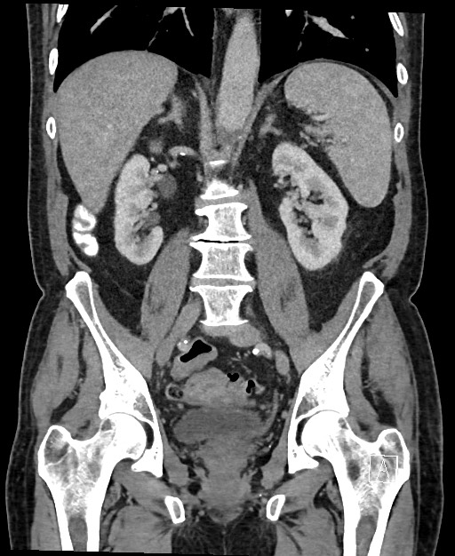 Active lower gastrointestinal bleeding - diverticular (Radiopaedia 61203-69106 Coronal C+ portal venous phase 83).jpg