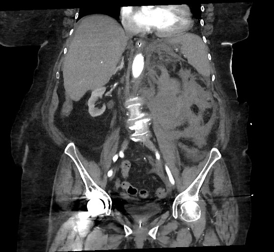 Active renal extravasation with large subcapsular and retroperitoneal hemorrhage (Radiopaedia 60975-68796 Coronal C+ arterial phase 86).jpg