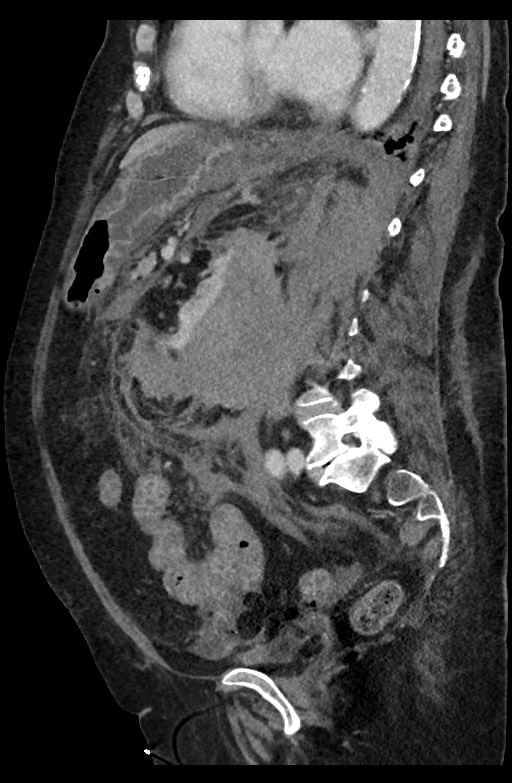 Active renal extravasation with large subcapsular and retroperitoneal hemorrhage (Radiopaedia 60975-68796 Sagittal C+ portal venous phase 102).jpg
