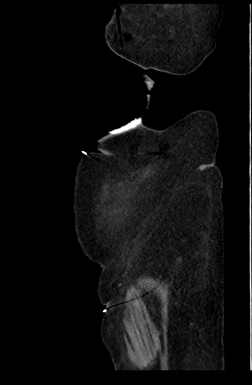 Active renal extravasation with large subcapsular and retroperitoneal hemorrhage (Radiopaedia 60975-68796 Sagittal C+ portal venous phase 31).jpg