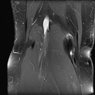 File:Acute-on-chronic transient lateral patellar dislocation with trochlear dysplasia (Radiopaedia 84099-99349 Coronal PD fat sat 9).jpg