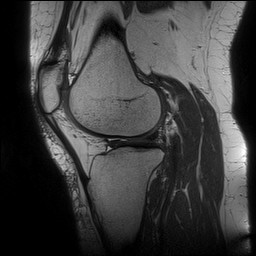 Acute-on-chronic transient lateral patellar dislocation with trochlear dysplasia (Radiopaedia 84099-99349 Sagittal PD 106).jpg