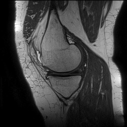Acute-on-chronic transient lateral patellar dislocation with trochlear dysplasia (Radiopaedia 84099-99349 Sagittal PD 55).jpg