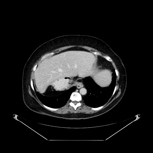 File:Acute appendicitis, heterotaxy syndrome (Radiopaedia 66884-76202 Axial 109).jpg
