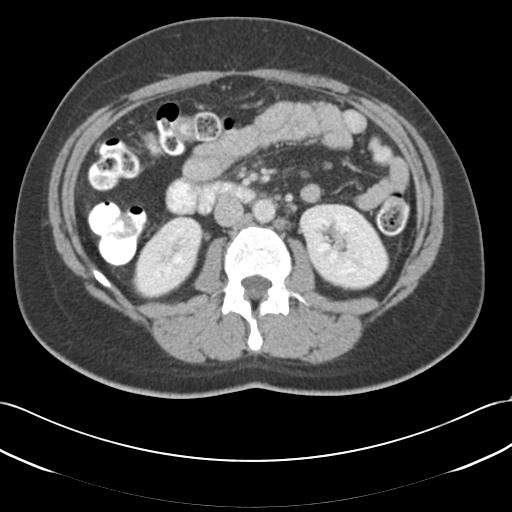 File:Acute appendicitis (Radiopaedia 30297-30934 Axial C+ portal venous phase 37).jpg