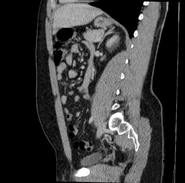 Acute appendicitis (Radiopaedia 38255-40270 Sagittal C+ portal venous phase 51).jpg