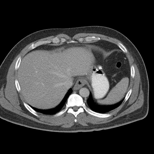 Acute appendicitis (Radiopaedia 48511-53463 Axial C+ portal venous phase 17).jpg