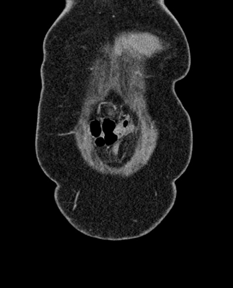 File:Acute appendicitis (Radiopaedia 48792-53822 Coronal C+ portal venous phase 21).jpg