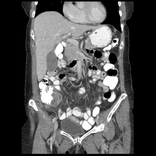 File:Acute appendicitis (Radiopaedia 52672-58589 Coronal C+ portal venous phase 31).jpg