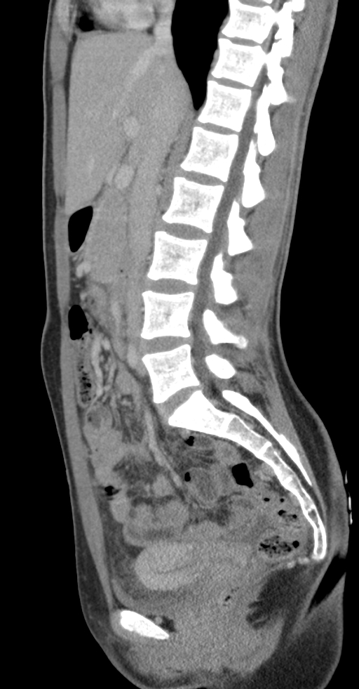 Acute appendicitis (Radiopaedia 62608-70901 Sagittal C+ portal venous phase 22).jpg