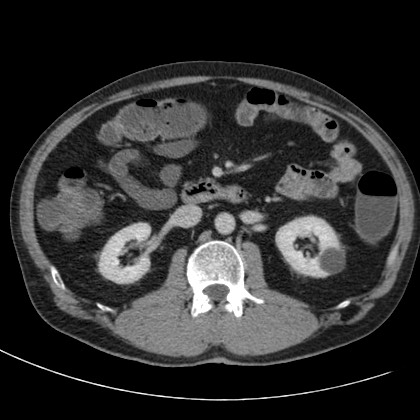 Acute appendicitis (Radiopaedia 66513-75790 Axial C+ portal venous phase 29).jpg