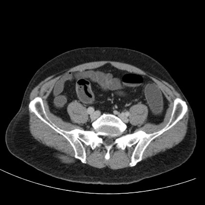 File:Acute appendicitis (Radiopaedia 66513-75790 Axial C+ portal venous phase 63).jpg