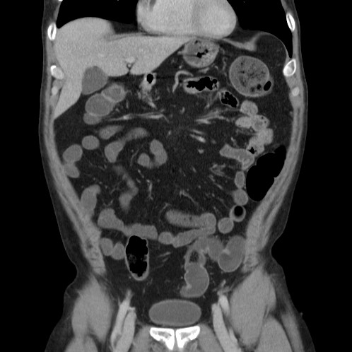 File:Acute appendicitis (Radiopaedia 66513-75790 Coronal C+ portal venous phase 18).jpg