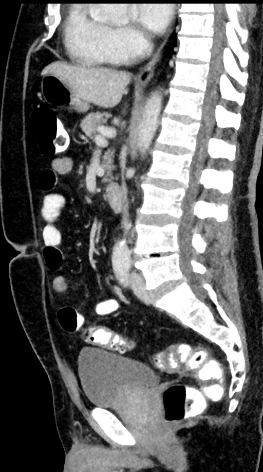 Acute appendicitis (Radiopaedia 77016-88960 Sagittal C+ portal venous phase 57).jpg